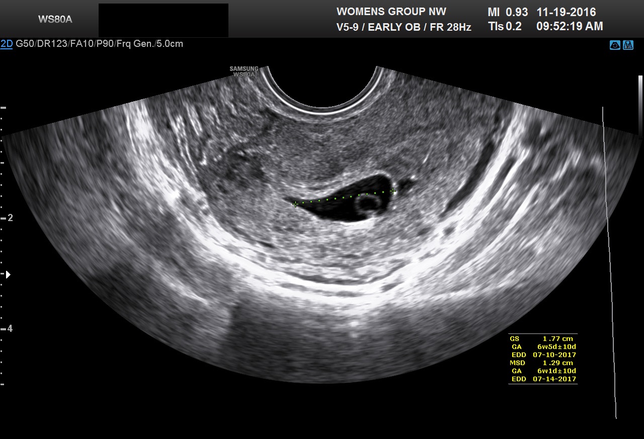 Mean Sac Diameter Chart - Ponasa