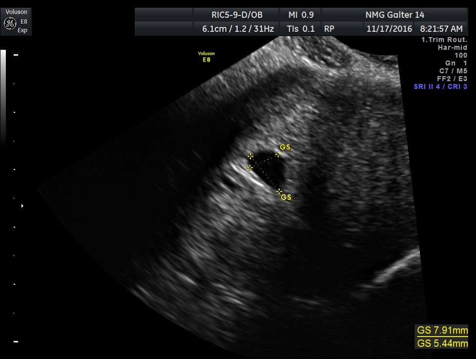 Gestational Sac in Pregnancy and Meaning If Empty