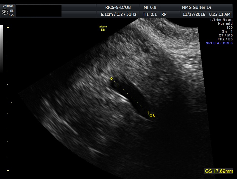 Ovarian Yolk Sac Tumor Ultrasound