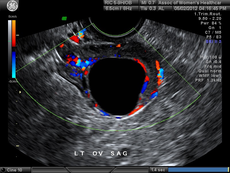 Diagnostic Ultrasound In The First Trimester Of Pregnancy Glowm 3029