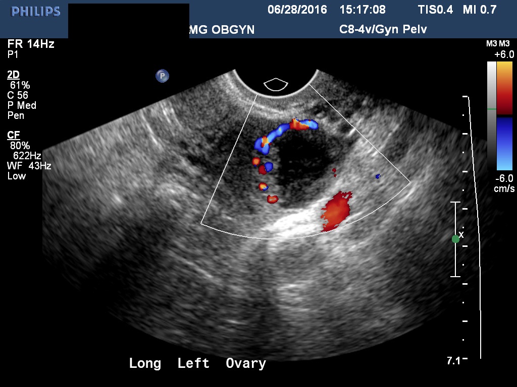 Diagnostic Ultrasound In The First Trimester Of Pregnancy Glowm