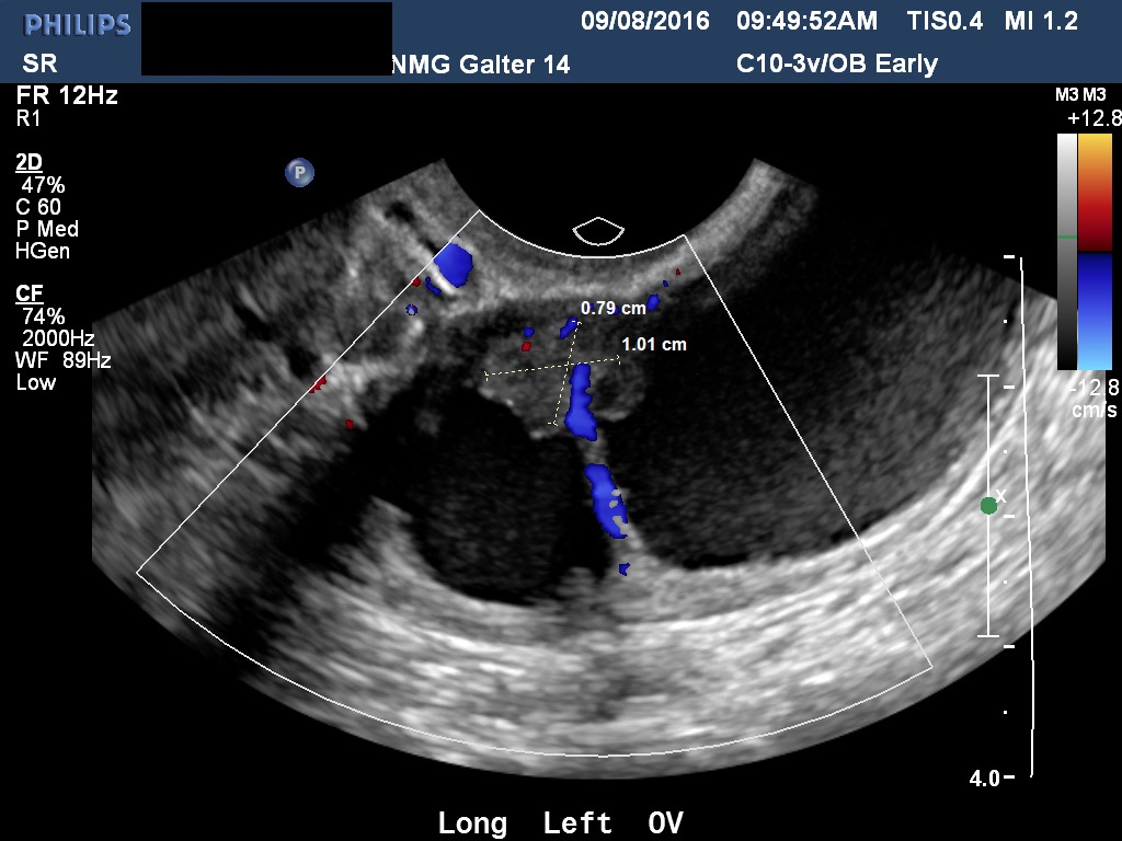 Diagnostic Ultrasound In The First Trimester Of Pregnancy Glowm