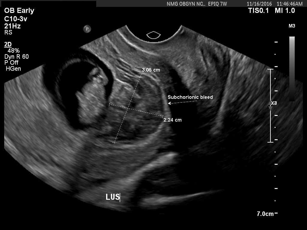 The significance of ultrasound features of sub-chorionic