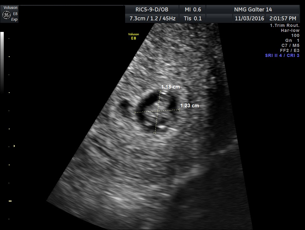 gestational sac size at 8 weeks