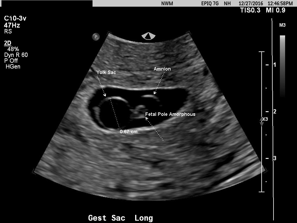 wood cruise microscopic Diagnostic Ultrasound in the First Trimester of Pregnancy | GLOWM