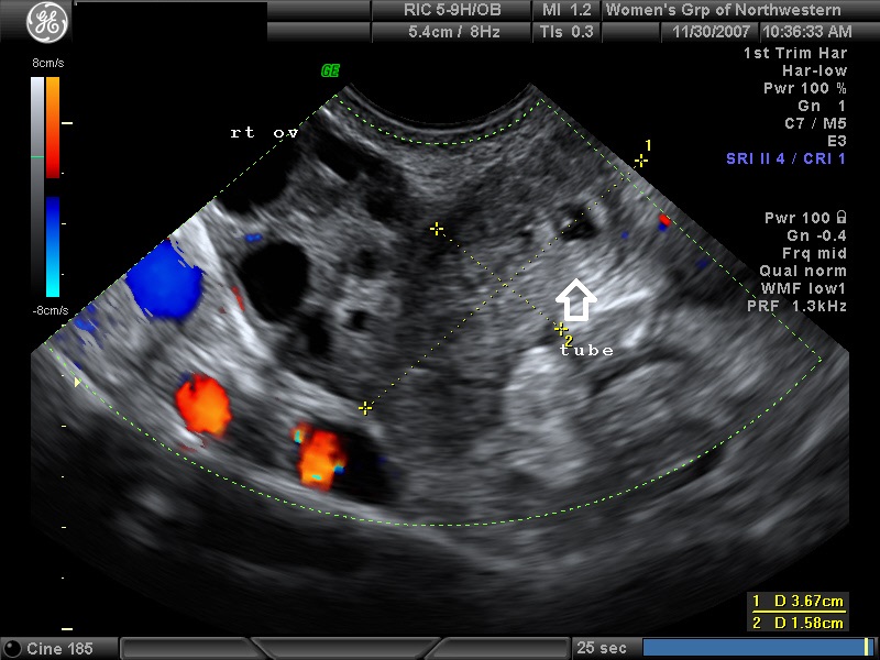 4 week vaginal ultrasound pictures