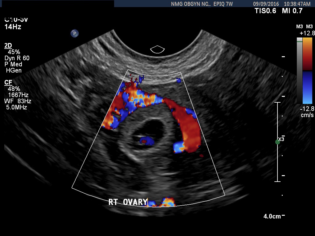 ovarian ectopic pregnancy ultrasound