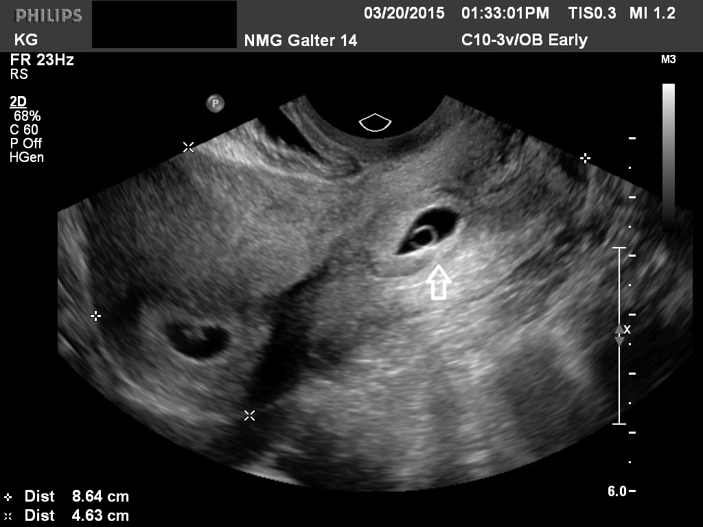 Diagnostic Ultrasound in the First Trimester of Pregnancy | GLOWM