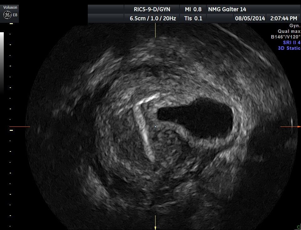 Diagnostic Ultrasound In The First Trimester Of Pregnancy Glowm