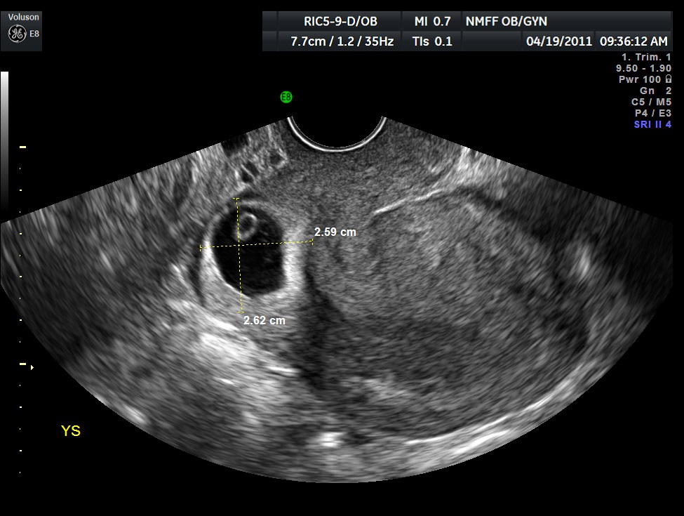 Trimester normal ultrasound first First Trimester