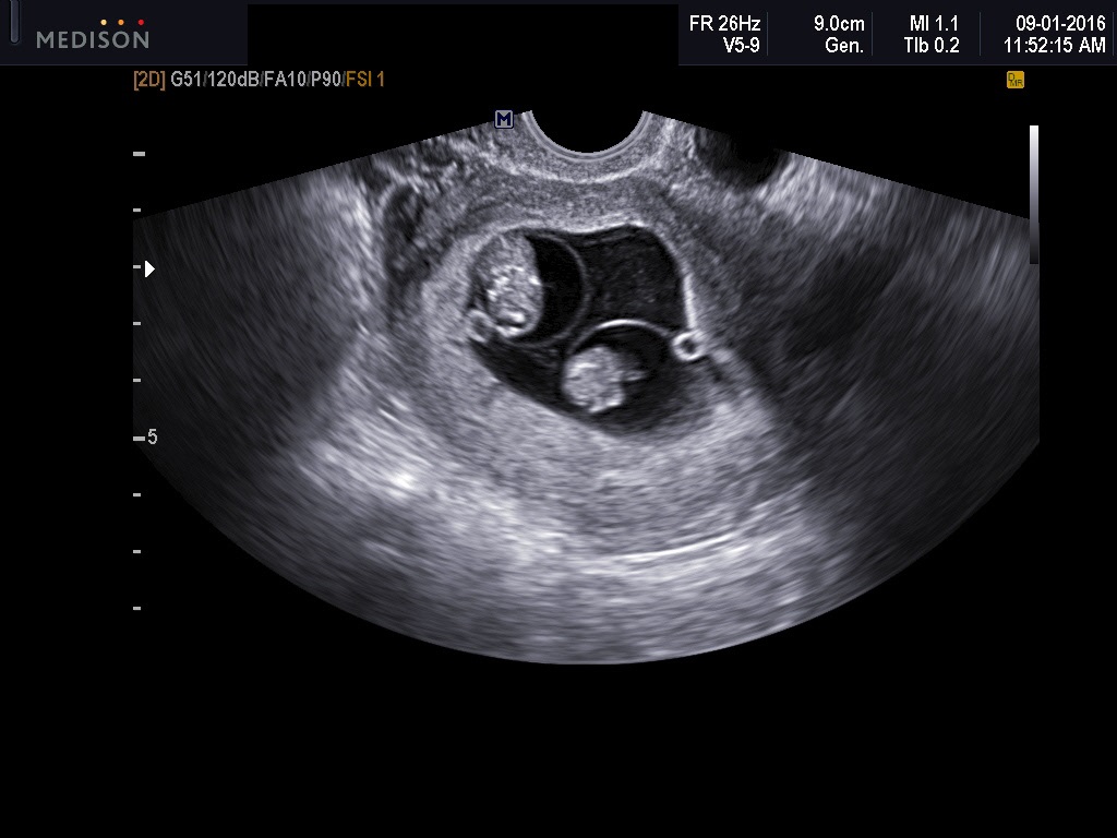 Ultrasound tilted sac uterus empty 6 weeks