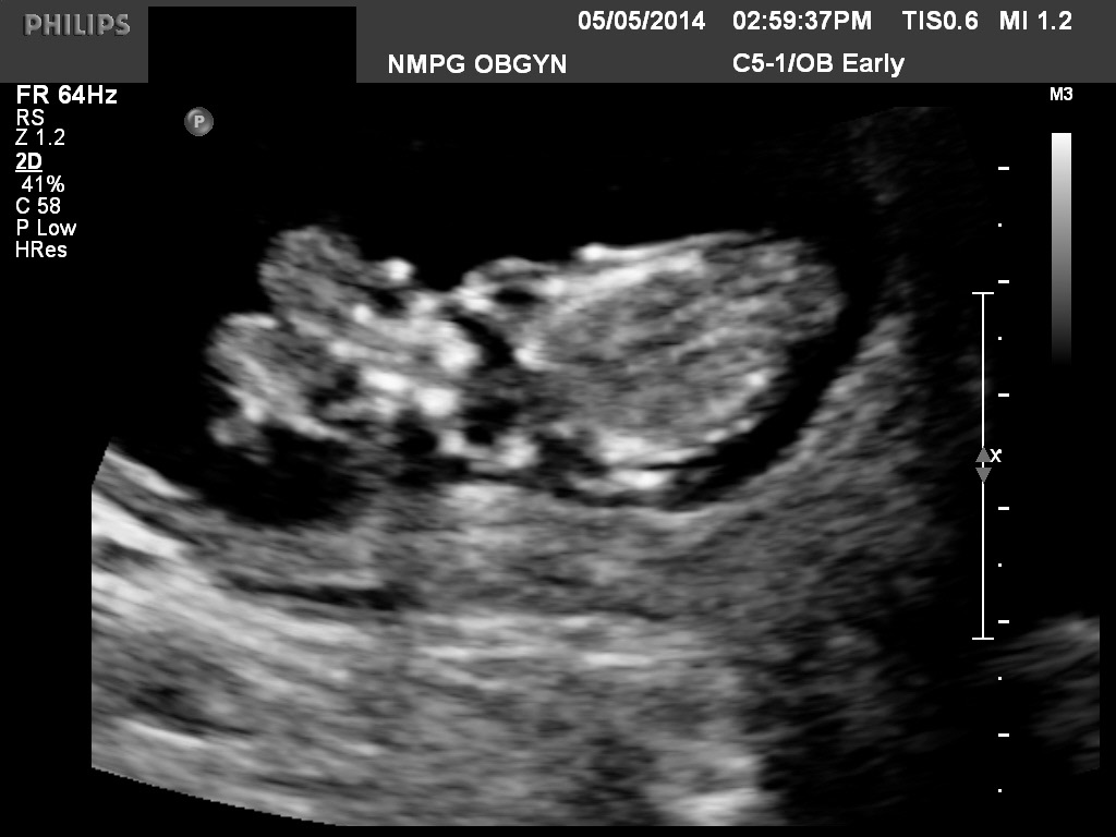 abnormal ultrasound 11 weeks