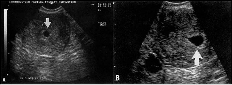 yolk sac 6 weeks