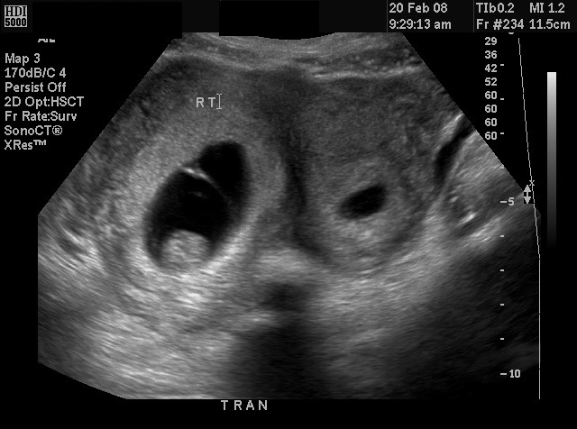 Diagnostic Ultrasound in the First Trimester of Pregnancy ... transvaginal ultrasound diagram 