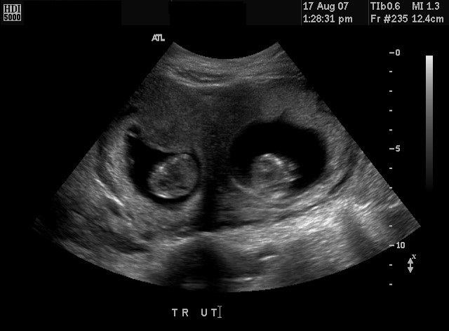 Diagnostic Ultrasound In The First Trimester Of Pregnancy Glowm